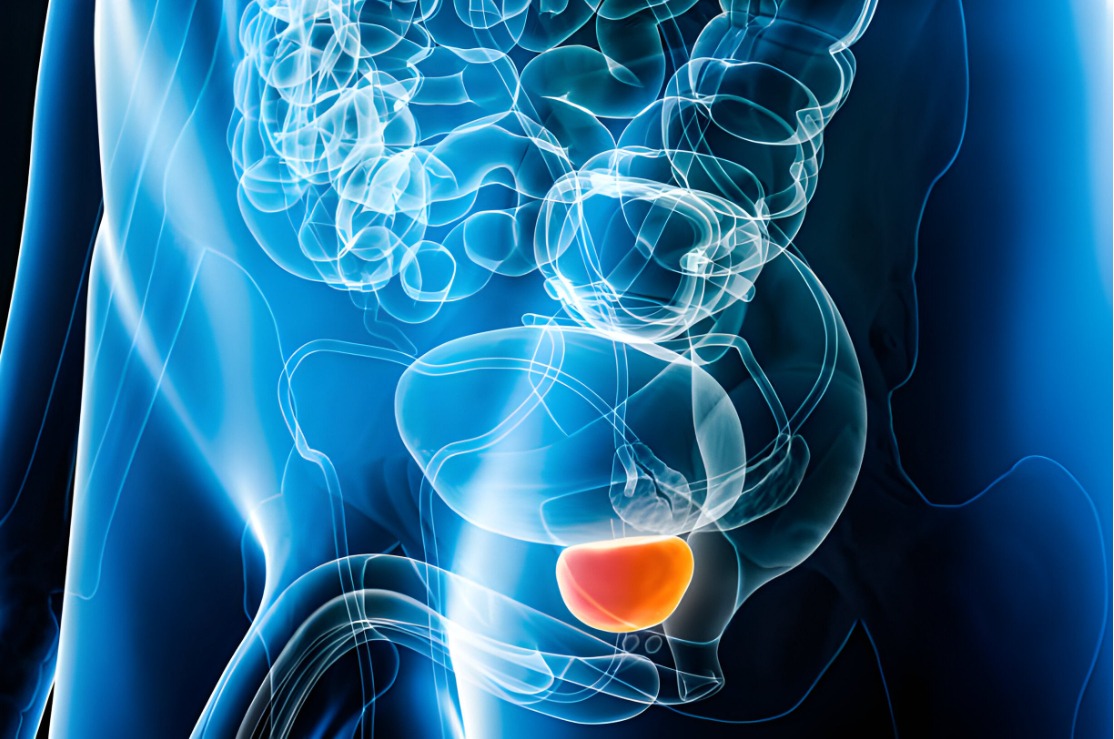 Los signos de cáncer de próstata avanzado que debes conocer
