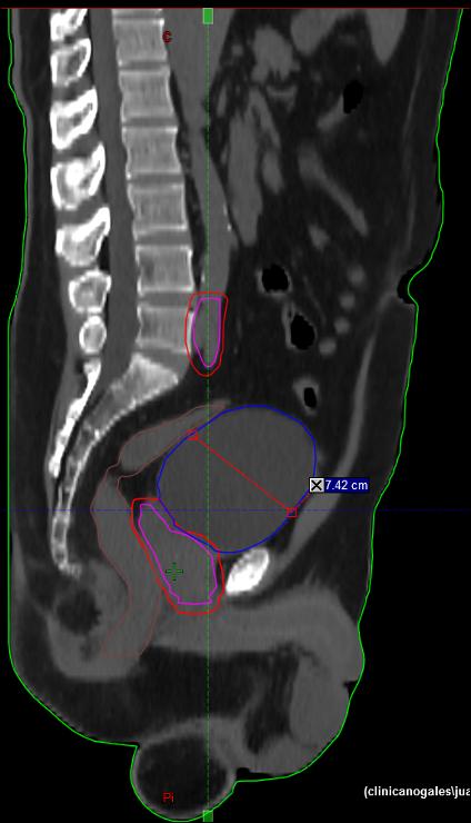 Imagen vertical del abdomen y pelvis